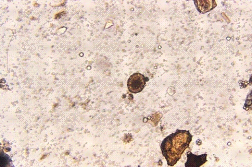 Identify the following:   A)  Ascaris lumbricoides B)  Strongyloides stercoralis C)  Hookworm D)  Schistosoma haematobium