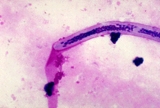 Identify the following:   A)  Brugia malayi B)  Loa loa C)  Wucheria bancrofti D)  Onchocerca volvulus