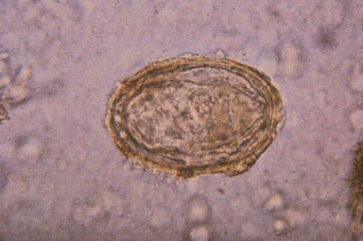 Identify the following:   A)  Schistosoma mansoni B)  S. japonicum C)  S. haematobium D)  S. madurella