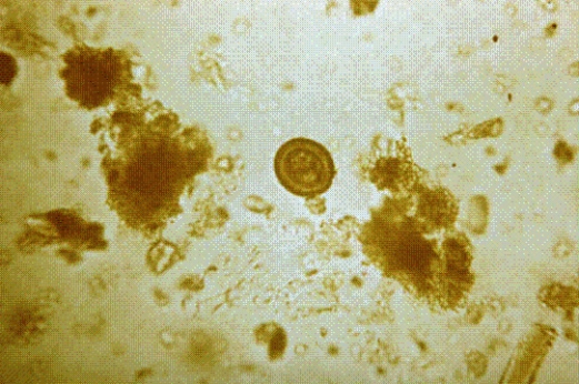 Identify the following:   A)  Hymenolepis nana B)  Taenia spp. C)  Diphyllobothrium latum D)  Paragonimus westermani