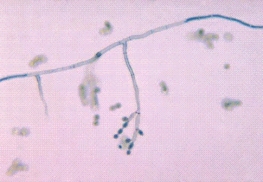 A graduate student returning from a month-long fieldwork experience in South America develops a dark nodular lesion on his left hand.Microscopic examination of the nodule reveals dark, coinlike inclusions.The following organism grows in culture.This organism is most likely:   A) Cladosporium spp. B) Candida spp. C) Coccidioides immitis. D) Cryptococcus neoformans.