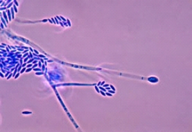 A patient who wears long-term contact lenses comes to her physician after noting a small spot on her cornea.Collection of the lesion for culture produced a fast-growing mold with a slight pink color on the surface.Microscopic review showed the following organism.This organism is most likely:   A) Sporothrix schenckii. B) Fusarium spp. C) Mucor spp. D) Geotrichum spp.