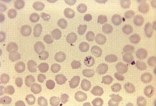 A 15-year-old boy spent most of the summer at the northern Minnesota family cabin on a lake in a densely wooded area.After returning to school in the fall, he was frequently tired and listless with periods of fever and chills.A blood sample taken at the physician's office revealed the following organism.The most likely identification is:   A) Plasmodium ovale. B) Babesia microti. C) Plasmodium malariae. D) Trypanosoma cruzi.