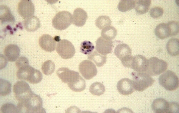A woman patient with history of travel to tropical Africa was noncompliant with her antimalarial medications.She now has a cyclical fever and paroxysm every 72 hours.The following organism is seen in her peripheral blood smear consistent with an infection caused by:   A) Plasmodium ovale. B) P.vivax. C) P.falciparum. D) P.malariae.