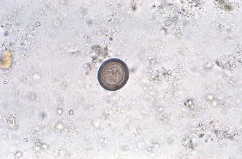A patient finds a small ribbon-like piece in his stool sample and reports this to his physician.The physician orders a fecal O&P analysis that reveals the following egg in the sample.The most likely identity of this parasite is:   A) Hymenolepis nana. B) Taenia spp. C) Diphyllobothrium latum. D) Paragonimus westermani.