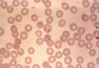 A patient comes to the emergency room stating that he has fever and chills every 48 hours.The patient has a history of travel to Central America in the past month and did not take any preventative measures against malaria.A complete blood count (CBC)  shows the following RBC inclusions.This organism is most likely:   A) Plasmodium malariae. B) P.ovale. C) P.falciparum. D) P.vivax.