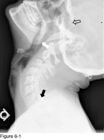   -The structure marked by the black open arrow is the __________. A)  Nasopharynx B)  Ethmoid sinus C)  Sella turcica D)  Maxillary sinus