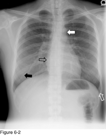  -The structure marked by the black open arrow is the __________. A)  Right atrium B)  Right ventricle C)  Left atrial D)  Left ventricle