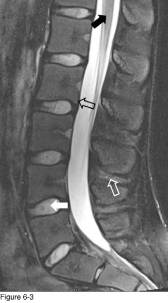   -The structure indicated by the black open arrow is the __________. A)  Anterior longitudinal ligament B)  Posterior longitudinal ligament C)  Epidural fat D)  Ligamentum flavum