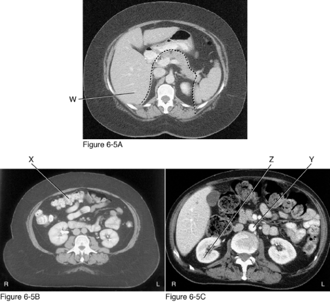  -What structure is indicated by X in Figure 6-5B? A)  Ascending colon B)  Transverse colon C)  Descending colon D)  Sigmoid colon