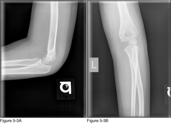   -The radiographic density of the salient abnormality in Figure 5-4 is that of __________. A)  air B)  fat C)  bone D)  metal