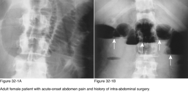   -The upper limit of normal for small bowel diameter when distended by gas is __________ cm. A)  2 B)  3 C)  4 D)  5
