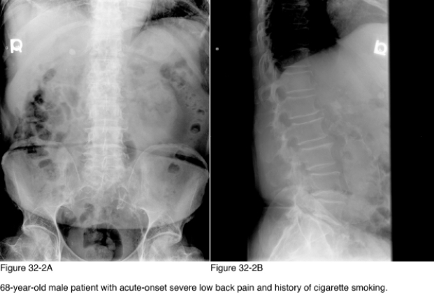   -Which of the following is the most significant abnormality noted in the radiographs in Figure 32-2? A)  Abdominal aortic aneurysm B)  Gallstone C)  Renal lithiasis D)  Ureteral lithiasis