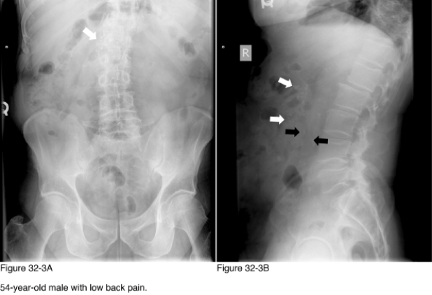   -The condition responsible for the calcifications indicated by the white arrows in Figure 32-3 is __________. A)  Alcoholic pancreatitis B)  Pseudocysts C)  Hyperparathyroidism D)  Pancreatic cancer