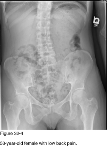   -In Figure 32-4, the calcification within the pelvic soft tissues is characteristic for __________. A)  Appendicolith B)  Bladder calculus C)  Dermoid cyst D)  Uterine leiomyoma