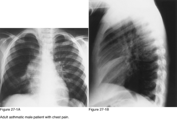   -The triangular-shaped density noted on the lateral chest radiograph represents the right __________. A)  Hilum B)  Upper lobe C)  Middle lobe D)  Lower lobe