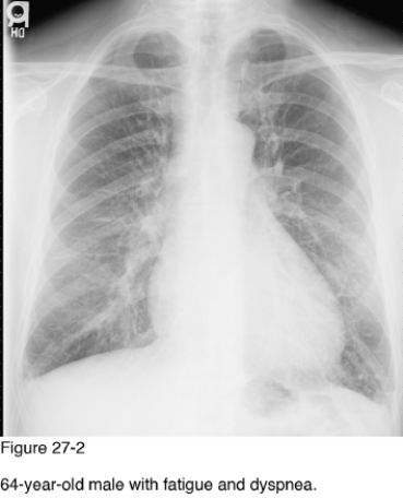   -Which of the following diagnoses best accounts for the radiographic abnormalities in Figure 27-2? A)  Cardiogenic pulmonary edema B)  Aspiration pneumonia C)  Adult respiratory distress syndrome D)  Neurogenic pulmonary edema