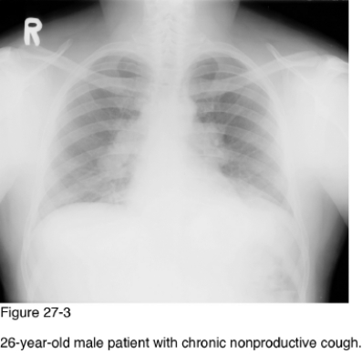   -Which of the following conditions would be most likely if enlarged right paratracheal nodes were also present on the radiographs and Figure 27-3? A)  Bronchogenic carcinoma B)  Lymphoma C)  Leukemia D)  Sarcoidosis