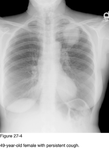   -Which of the following diagnoses would be most likely if this patient disclosed a history of cigarette smoking? A)  Bronchiocarcinoid tumor B)  Bronchogenic carcinoma C)  Bronchogenic cyst D)  Metastasis