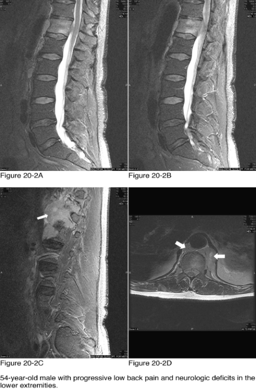   -Which of the following best explains the abnormality indicated by the white arrows in Figure 20-2C and Figure 20-2D? A)  Abscess B)  Paraspinal soft tissue mass C)  Paraspinal musculature D)  Hemorrhage