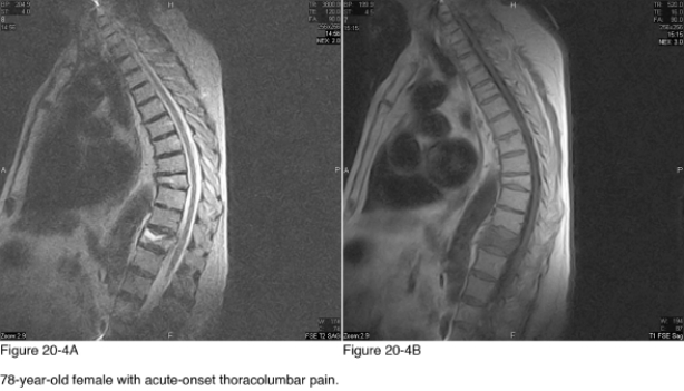   -Which of the following best describes the shape of the T11 vertebra? A)  Pancake B)  Biconcave C)  Step-off D)  Bullet