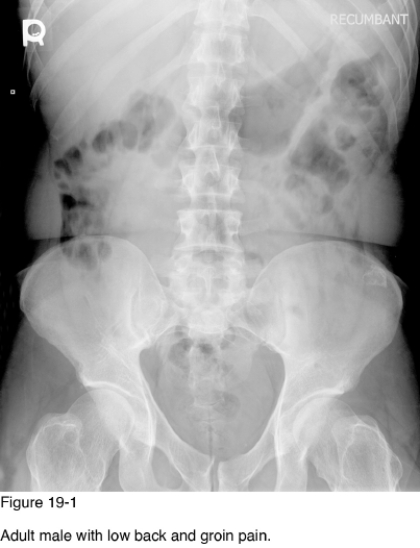   -Development of pain in the regions of involvement with enlargement of the lesions is a sign of __________. A)  Metastasis B)  Pathologic fracture C)  Malignant degeneration D)  Accessory bursa formation