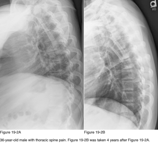   -Which laboratory value is likely to be elevated in this patient? A)  Alkaline phosphatase B)  Urinary hydroxyproline C)  Serum calcium D)  Acid phosphatase