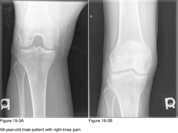   -Which of the following tests is considered diagnostic for this patient's disease? A)  Biopsy B)  Joint aspiration with microscopic assessment C)  Blood laboratory D)  Magnetic resonance imaging