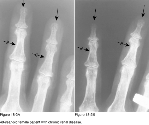   -Which of the following diagnoses would be most likely if the radiographs demonstrate changes similar to those marked by the black arrows, with diffuse sclerosis observed in the bones of the hand in a patient with short stature? A)  Arteriosclerosis obliterans B)  Sarcoidosis C)  Pyknodysostosis D)  Progressive systemic sclerosis