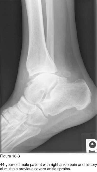   -Which of the following radiographic findings supports your answer to the most likely cause of the abnormalities observed in Figure 18-3? A)  Nonuniform reduction of joint spacing B)  Polyarticular involvement C)  Soft tissue swelling D)  Joint disintegration