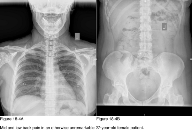   -What further action/diagnostic testing is necessary to manage this patient specific to the radiographic abnormalities noted in Figure 18-4? A)  No further action B)  Radiographic survey of the major joints C)  Referral to an oncologist D)  Referral to a rheumatologist