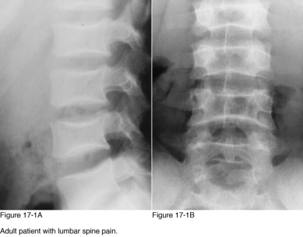   -Which of the following is the most common etiology for the change in vertebral body shape identified in Figure 17-1? A)  Osteoporosis B)  Thalassemia C)  Osteomalacia D)  Congenital abnormality