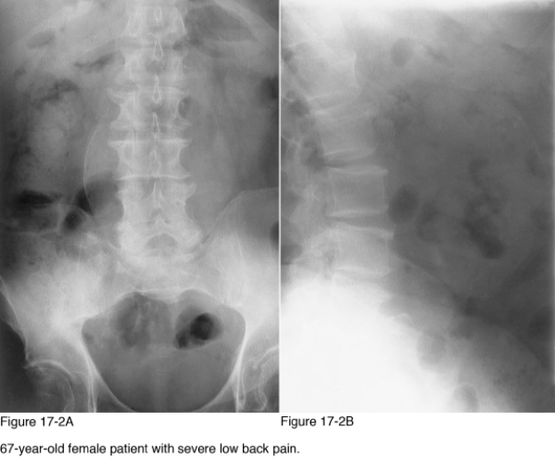   -Which infection is most likely to result in paraspinal calcification secondary to abscess formation? A)  Salmonella B)  Staphylococcus aureus C)  Echinococcus granulosus D)  Mycobacterium tuberculosis