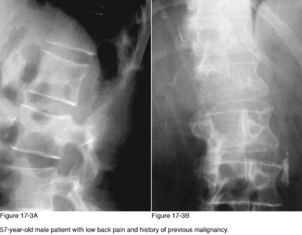   -Of the following, which is the most common cause of the salient abnormality in Figure 17-3? A)  Chordoma B)  Hemangioma C)  Metastasis D)  Multiple myeloma