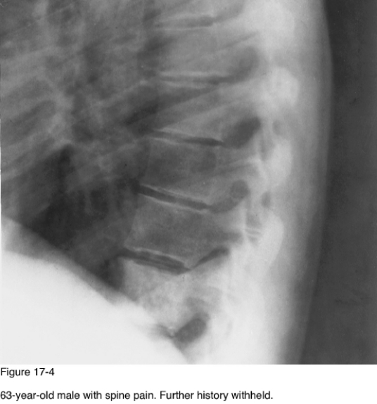   -Which of the following diagnoses would be most likely if radiographs showed multiple levels of endobones? A)  Albers-Schonberg disease B)  Paget disease C)  Fractures D)  Myelofibrosis