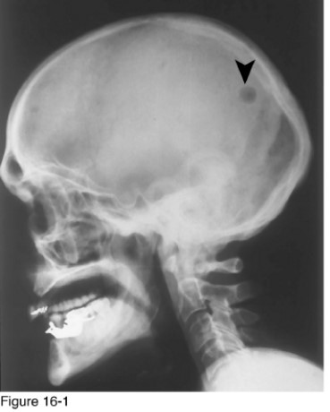   -Which of the following diagnoses would best explain the lesion, if on biopsy it was determined to contain ectodermal and mesodermal tissue? A)  Histiocytosis X B)  Multiple myeloma C)  Dermoid D)  Leptomeningeal cyst
