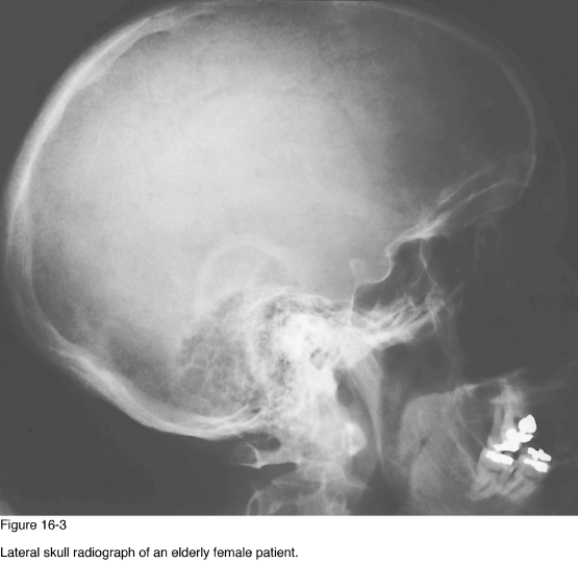   -Which of the following radiographic patterns of disease is represented in Figure 16-3? A)  Enlarged sella turcica B)  Basilar impression C)  Diffuse demineralization D)  Cystic lesion of the mandible
