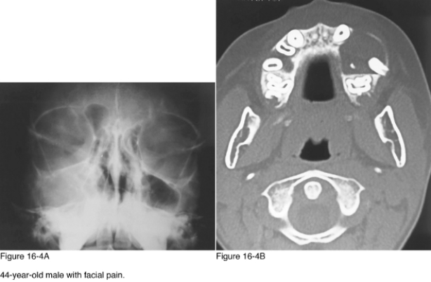   -Which of the following radiographic patterns of disease is represented in Figure 16-4A? A)  Mass in the paranasal sinus B)  Radiodense mandible lesions C)  Intracranial calcifications D)  Cystic lesions of the mandible and skull