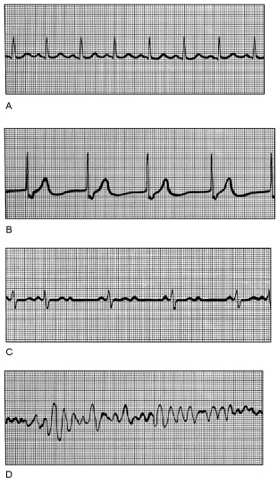   Figure 17.3 Using Figure 17.3, match the following: Ventricular fibrillation.<div style=padding-top: 35px> 
