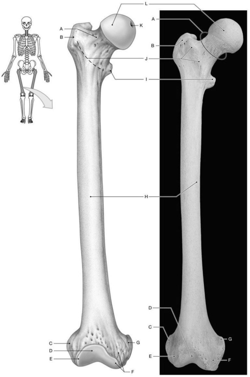 Figure 7.9     Using the above-referenced figures depicting the landmarks on the anterior surface of the right femur, identify the specified labeled part in each of the following questions. -Identify the structure indicated by Label F. A)  Lateral condyle B)  Lesser trochanter C)  Linea aspera D)  Greater trochanter E)  Medial condyle