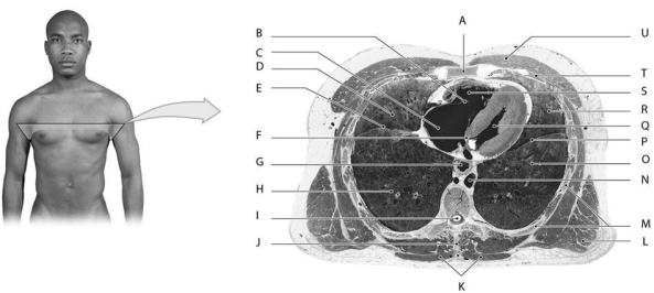 Figure 12.5     Using the above-referenced diagram of a cross section at the level of vertebra T8, identify the specified labeled structure(s)  in each of the following questions. -Identify the structure(s)  indicated by Label K. A)  Latissimus dorsi muscle B)  Pectoralis major muscle C)  Spinous process of T8 D)  Trapezius muscle E)  Rib 4