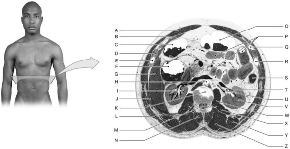 Figure 12.6     Using the above-referenced diagram of a cross-section at the level of vertebra T12, identify the specified labeled structure(s)  in each of the following questions. -Identify the structure(s)  indicated by Label G. A)  Kidney B)  Right lobe of liver C)  Spleen D)  Diaphragm E)  Intercostal muscles