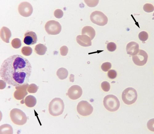 Identify the poikilocytes indicated by the arrows in the following image.   A) Acanthocytes B) Drepanocytes C) Schizocytes D) Spherocytes