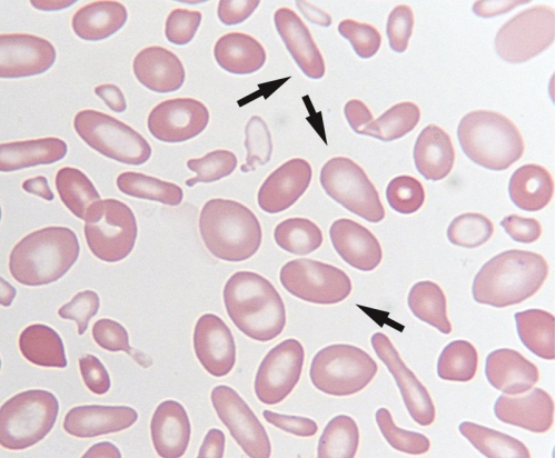 Which poikilocyte is indicated by the arrows in the following image?   A) Spherocytes B) Macrocytes C) Schistocytes D) Elliptocytes