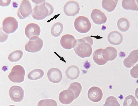 What should be reported about the RBCs indicated by the arrows in the following image?   A) Hypochromasia B) Drepanocytes C) Ovalocytes D) Macrocytes
