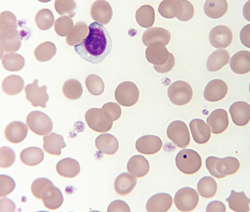 Identify the RBC inclusion in the following image.   A) Siderotic granule B) Basophilic stippling C) Howell Jolly body D) Heinz body