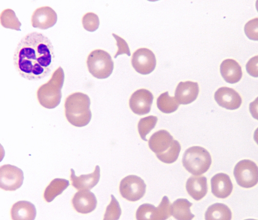 Identify the poikilocytes in the following image and indicate a possible mechanism for their formation.   A) Stomatocytes;liver disease B) Elliptocytes;iron deficiency C) Schisocytes;intravascular damage D) Codocytes;intracellular defect