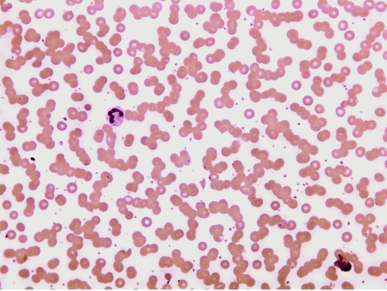 What should be reported about the RBCs in the following image and what affect would this have on the CBC results?   A) agglutination;increased MCV and decreased RBC count B) rouleaux;no affect on the CBC results C) codocytes;increased RBC count D) spherocytes;increased MCV