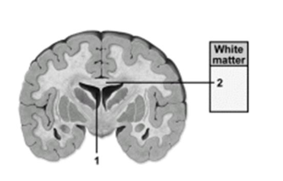   -This figure shows a frontal section of the cerebrum.What structure does number 2 indicate? A) Central canal B) Lateral ventricle C) Brainstem D) Corpus callosum E) Fourth ventricle