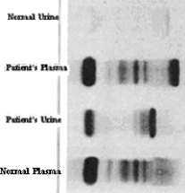 The following plasma and urine electrophoresis results were obtained from a 70-year-old man who complained to his doctor of back pain that he had had for several months and of feeling generally unwell.   This patient most likely has: A) Bence Jones protein. B) Hypergammaglobulinemia. C) Waldenström macroglobulinemia. D) Agammaglobulinemia. E) High levels of immunoglobulin M (IgM) .